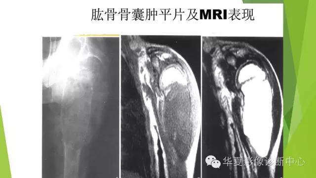 【病例】骨巨细胞瘤3例影像诊断与鉴别