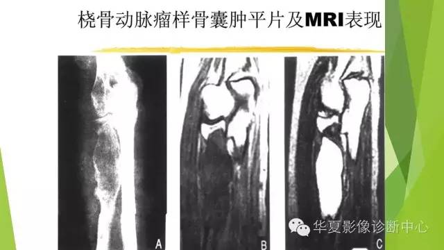 【病例】骨巨细胞瘤3例影像诊断与鉴别