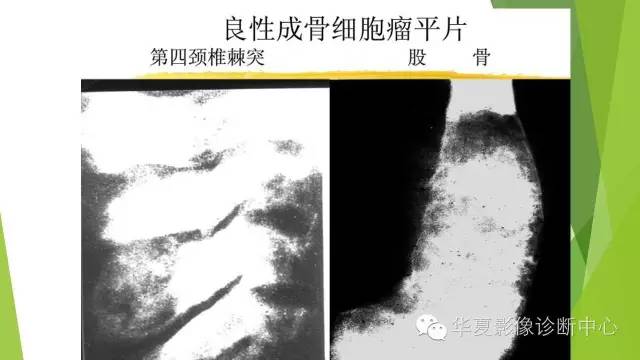 【病例】骨巨细胞瘤3例影像诊断与鉴别