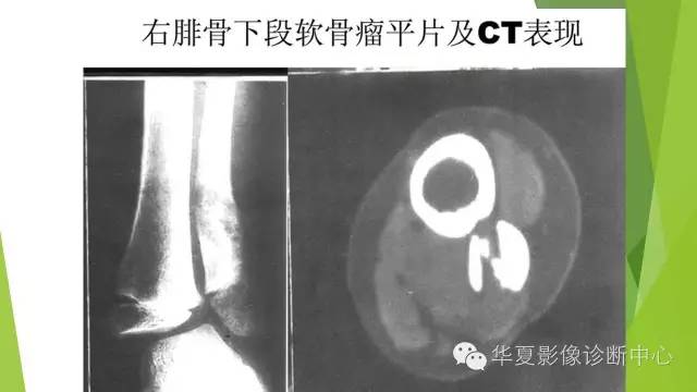 【病例】骨巨细胞瘤3例影像诊断与鉴别