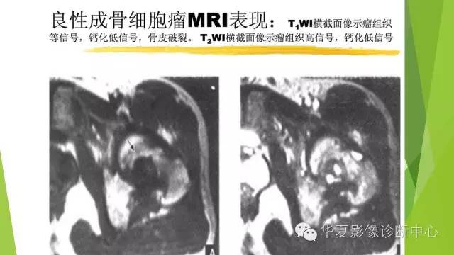 【病例】骨巨细胞瘤3例影像诊断与鉴别