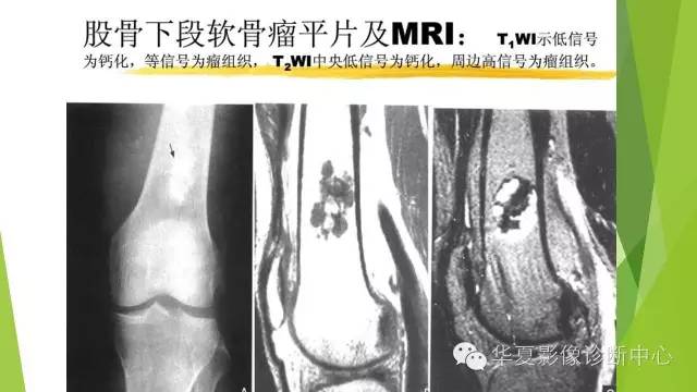 【病例】骨巨细胞瘤3例影像诊断与鉴别