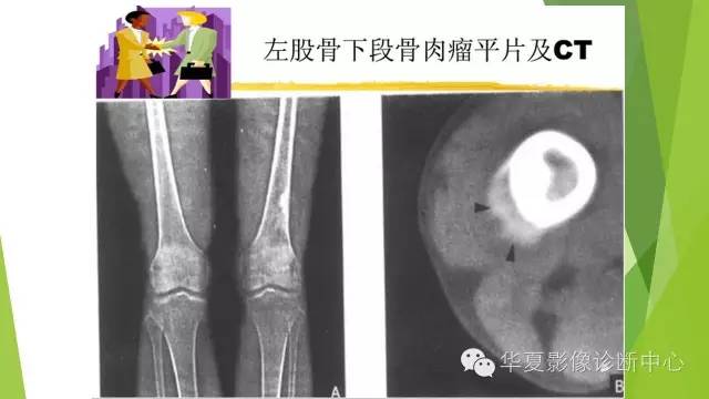 【病例】骨巨细胞瘤3例影像诊断与鉴别