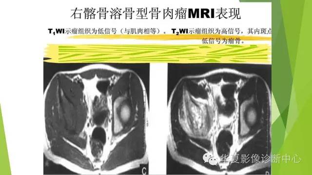 【病例】骨巨细胞瘤3例影像诊断与鉴别