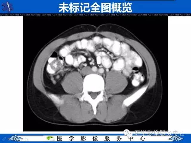 【PPT】盆腔解剖精要
