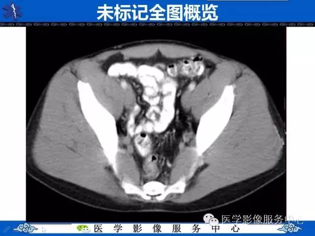 【PPT】盆腔解剖精要