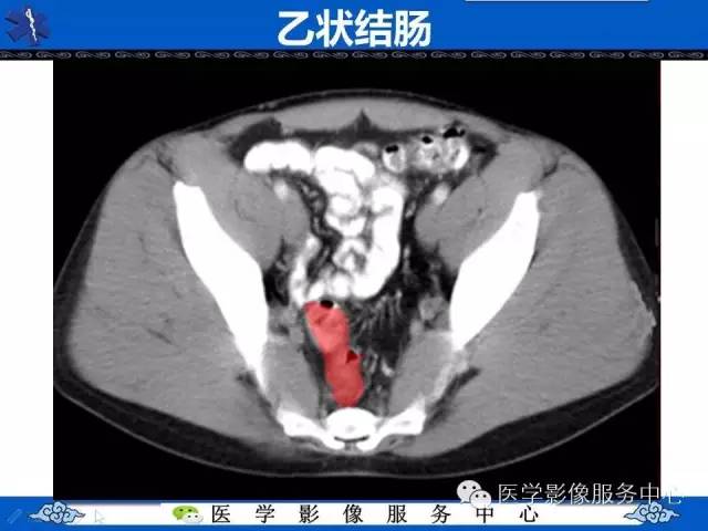 【PPT】盆腔解剖精要