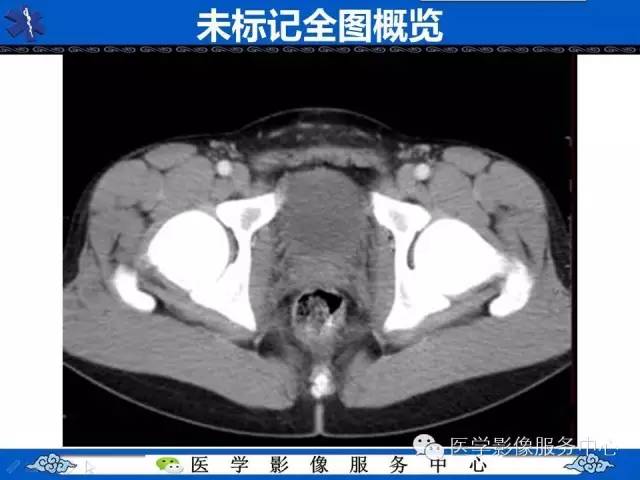 【PPT】盆腔解剖精要