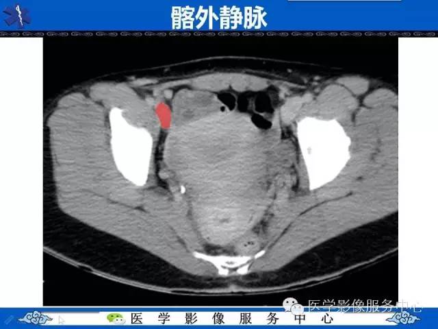 【PPT】盆腔解剖精要
