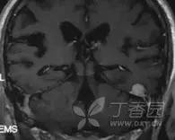 15 例不同位置脑膜瘤的MR表现 15 例不同位置脑膜瘤的MR表现