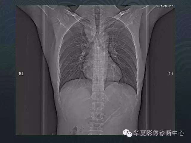 【病例】纵隔神经鞘瘤1例CT影像表现