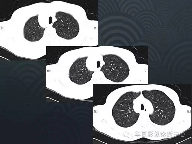 【病例】纵隔神经鞘瘤1例CT影像表现
