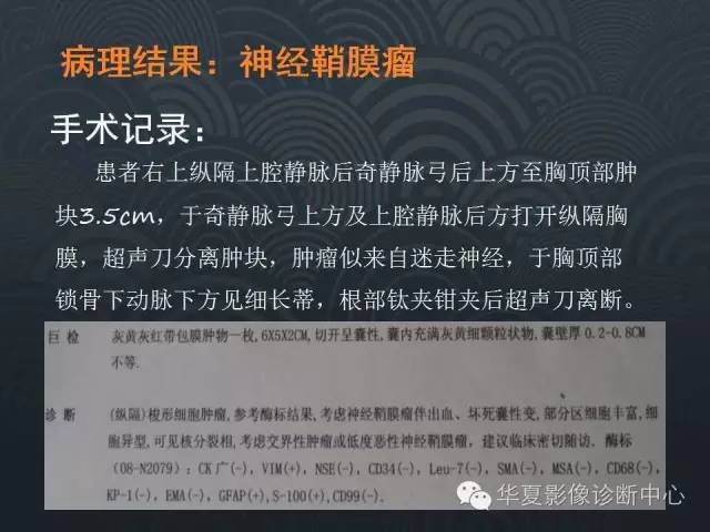 【病例】纵隔神经鞘瘤1例CT影像表现