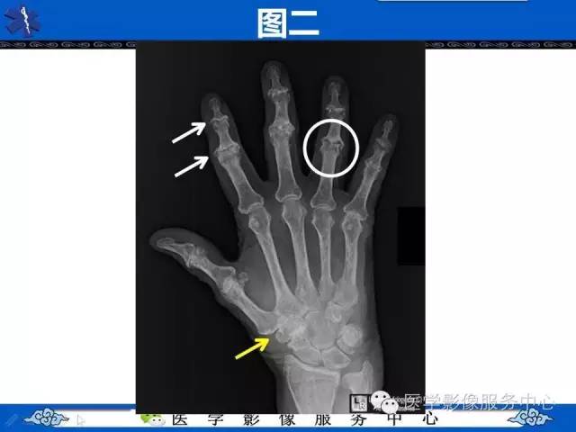 【影像征象】海鸥翼征——侵蚀性骨关节炎