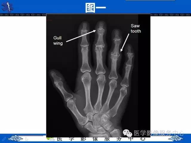 【影像征象】海鸥翼征——侵蚀性骨关节炎