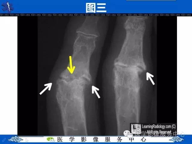 【影像征象】海鸥翼征——侵蚀性骨关节炎