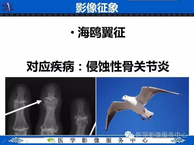 【影像征象】海鸥翼征——侵蚀性骨关节炎