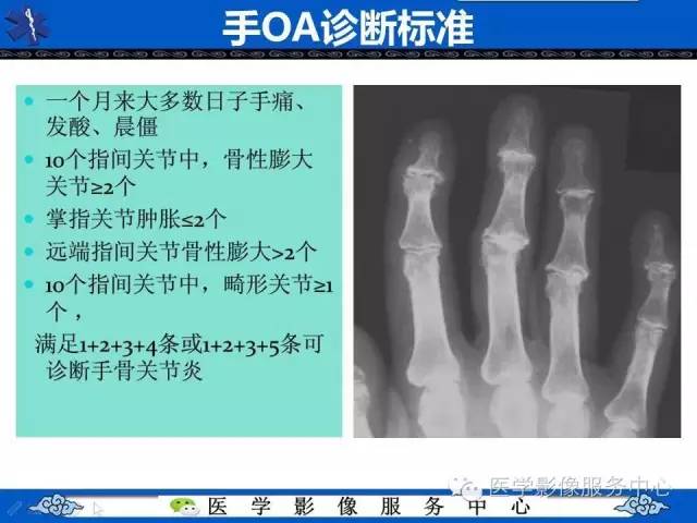 【影像征象】海鸥翼征——侵蚀性骨关节炎