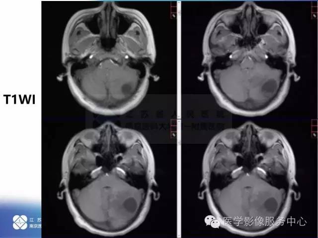 【病例】小脑不典型脑膜瘤1例MR影像表现 【病例】小脑不典型脑膜瘤1例MR影像表现