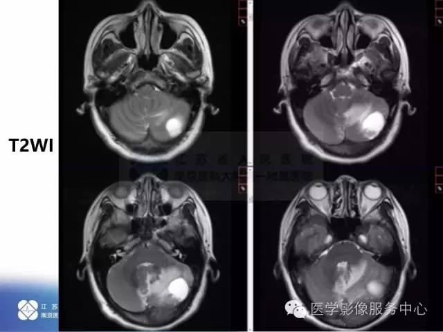 【病例】小脑不典型脑膜瘤1例MR影像表现 【病例】小脑不典型脑膜瘤1例MR影像表现