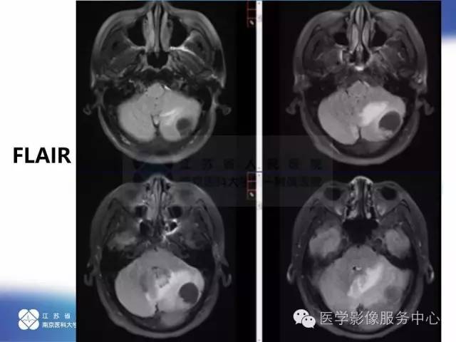 【病例】小脑不典型脑膜瘤1例MR影像表现 【病例】小脑不典型脑膜瘤1例MR影像表现