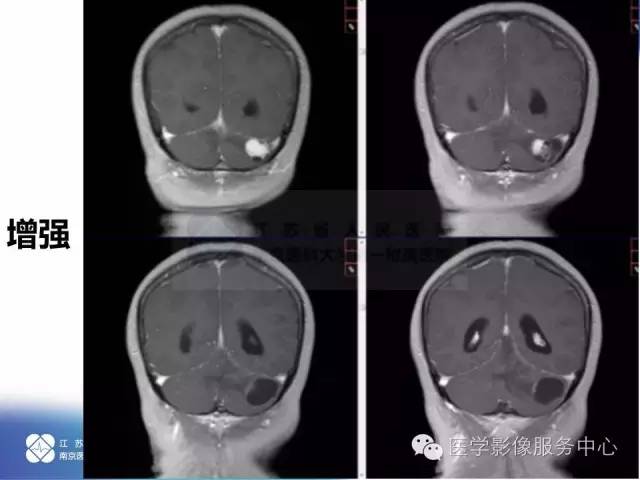 【病例】小脑不典型脑膜瘤1例MR影像表现 【病例】小脑不典型脑膜瘤1例MR影像表现