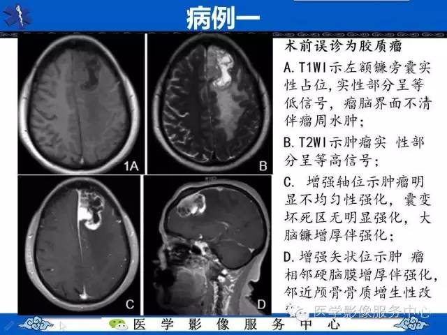 【病例】小脑不典型脑膜瘤1例MR影像表现 【病例】小脑不典型脑膜瘤1例MR影像表现