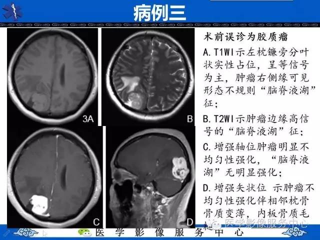 【病例】小脑不典型脑膜瘤1例MR影像表现 【病例】小脑不典型脑膜瘤1例MR影像表现