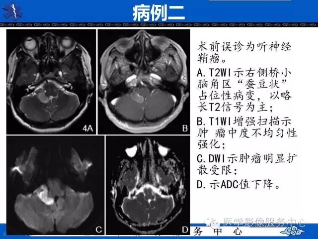 【病例】小脑不典型脑膜瘤1例MR影像表现 【病例】小脑不典型脑膜瘤1例MR影像表现