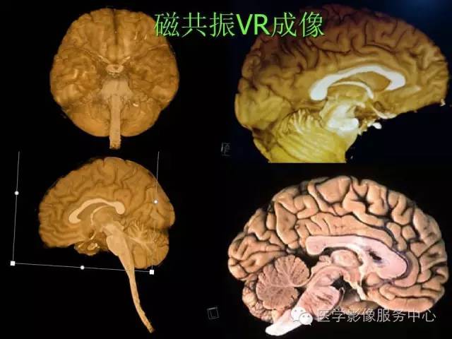 【PPT】小脑脚-磁共振DTI成像