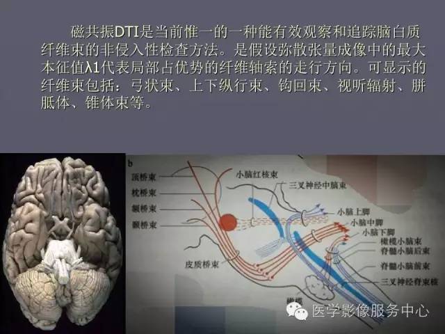 【PPT】小脑脚-磁共振DTI成像