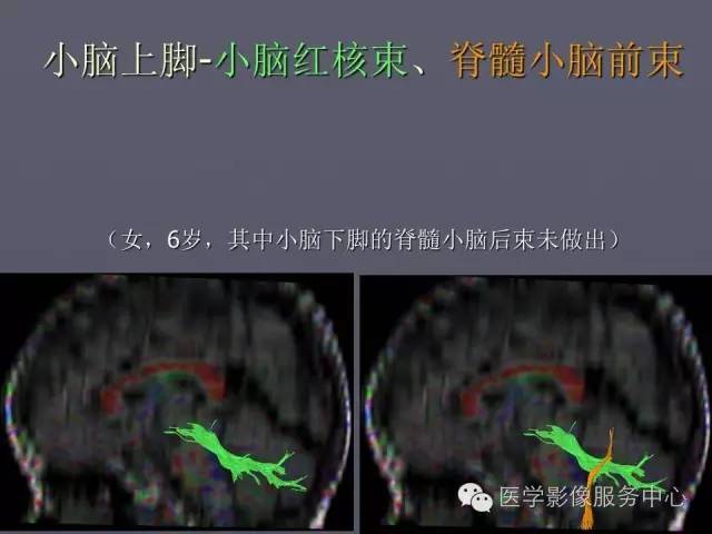 【PPT】小脑脚-磁共振DTI成像