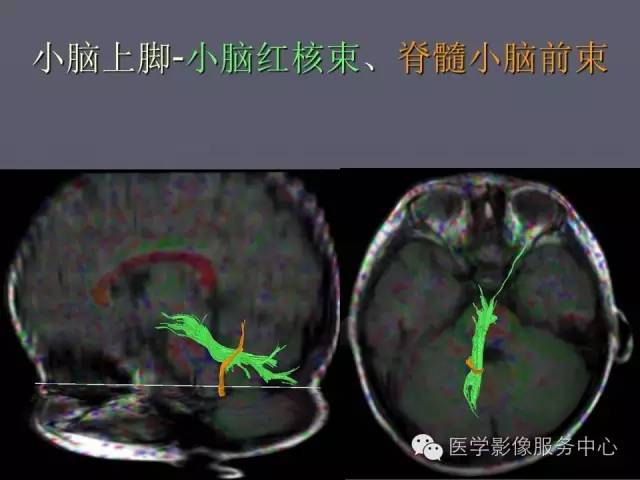 【PPT】小脑脚-磁共振DTI成像