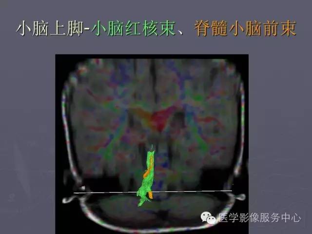 【PPT】小脑脚-磁共振DTI成像