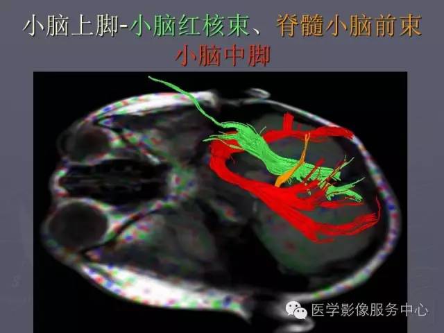 【PPT】小脑脚-磁共振DTI成像