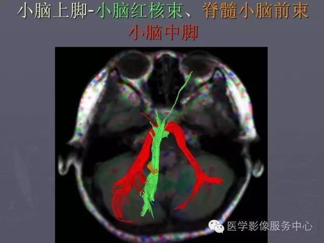 【PPT】小脑脚-磁共振DTI成像