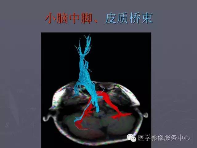 【PPT】小脑脚-磁共振DTI成像