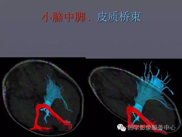 【PPT】小脑脚-磁共振DTI成像