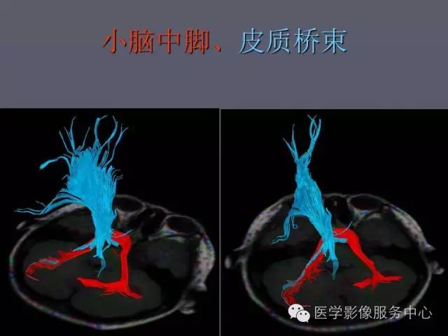 【PPT】小脑脚-磁共振DTI成像