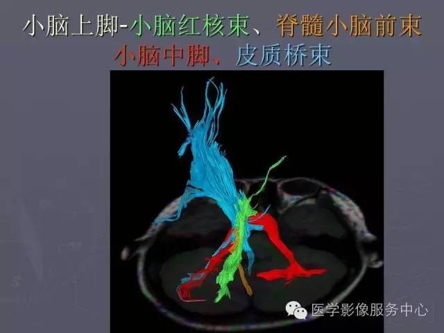【PPT】小脑脚-磁共振DTI成像