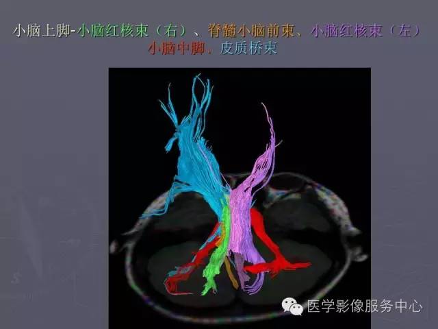 【PPT】小脑脚-磁共振DTI成像