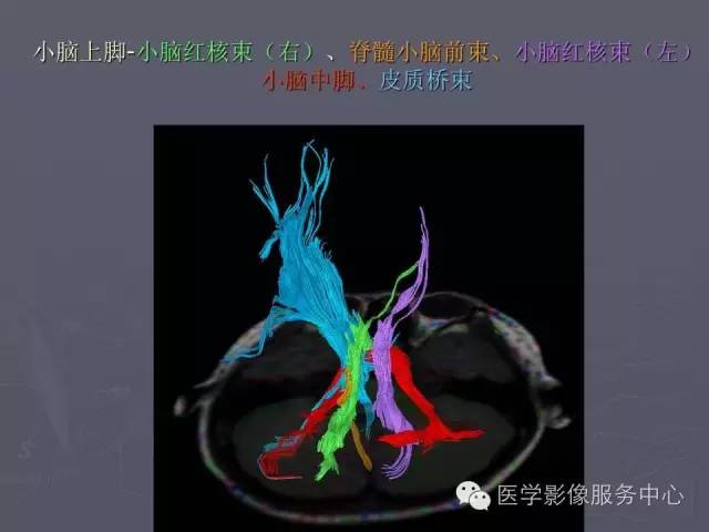【PPT】小脑脚-磁共振DTI成像