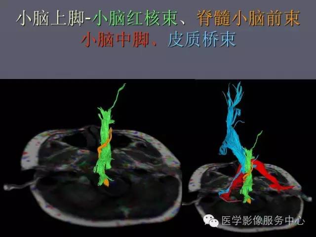 【PPT】小脑脚-磁共振DTI成像