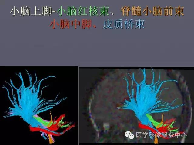 【PPT】小脑脚-磁共振DTI成像