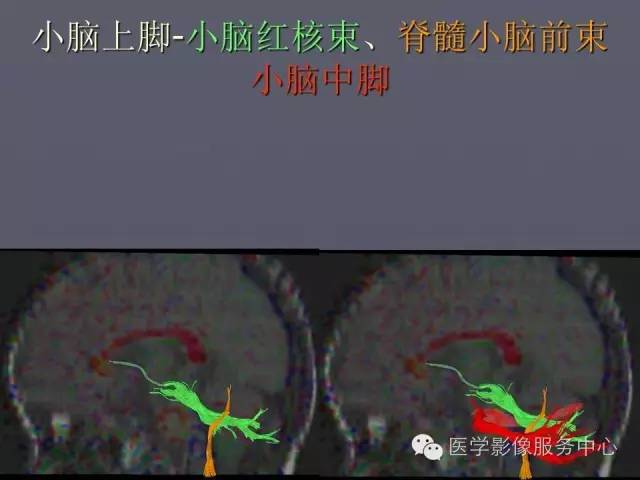 【PPT】小脑脚-磁共振DTI成像