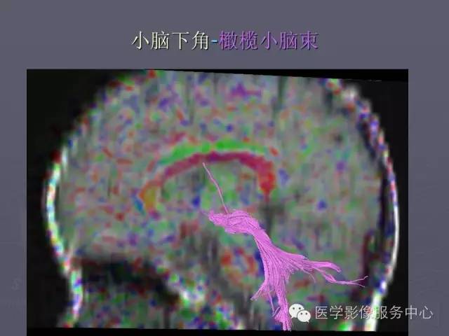 【PPT】小脑脚-磁共振DTI成像