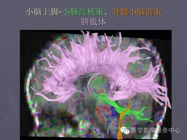 【PPT】小脑脚-磁共振DTI成像