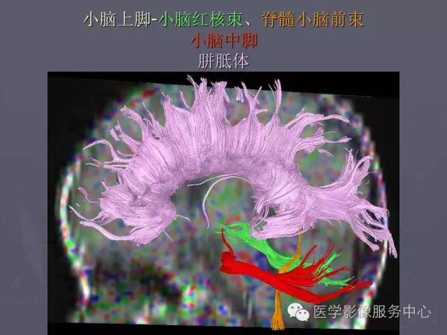 【PPT】小脑脚-磁共振DTI成像
