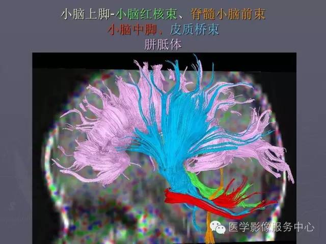 【PPT】小脑脚-磁共振DTI成像