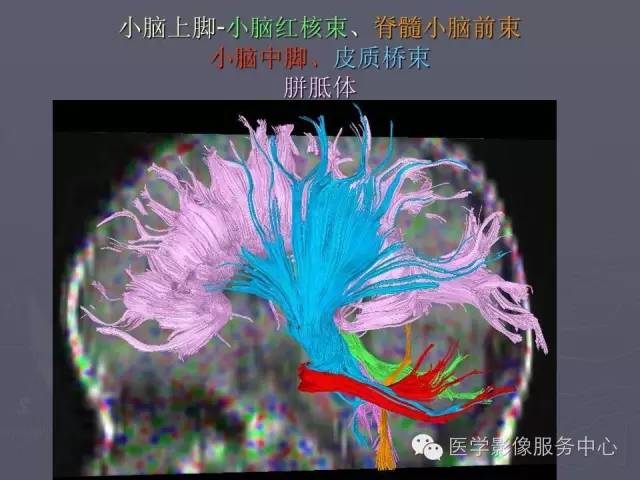 【PPT】小脑脚-磁共振DTI成像